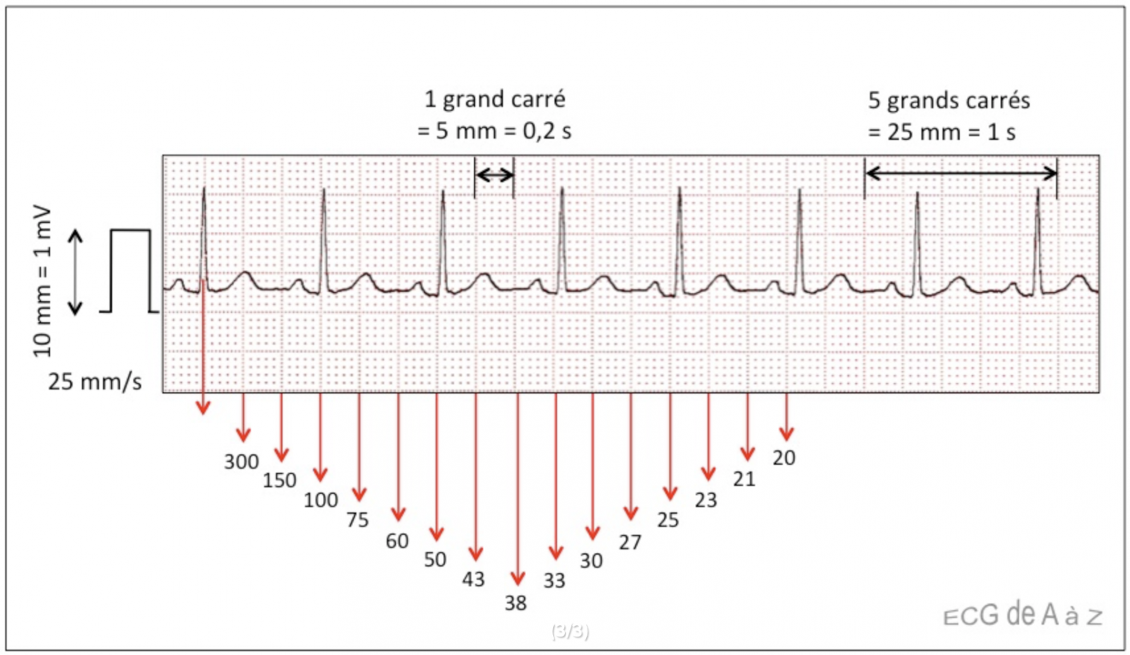 LEXIPatho: Électrocardiogramme (ECG) : Indications Et Interprétations